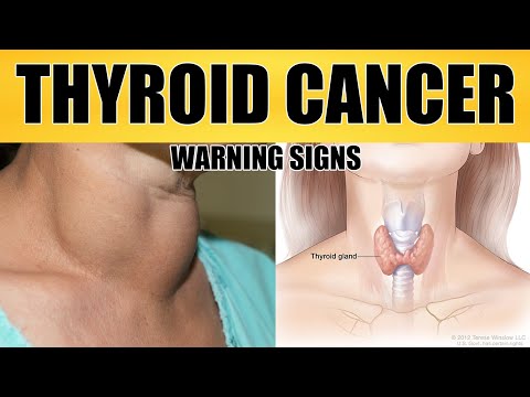 5 warning signs of thyroid cancer you must not ignore.#thyroid #cancer#warnimgs #signs#thyroidcancer [Video]