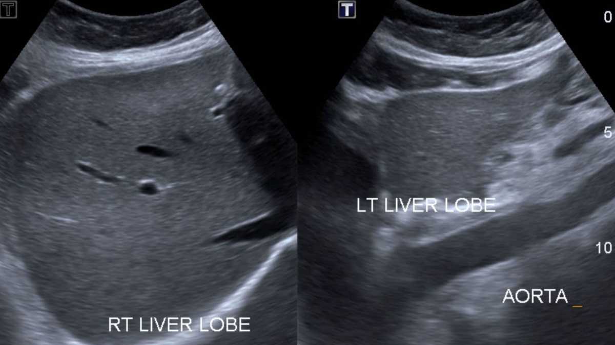New US liver transplant policy raises cost and equity concerns, according to new study [Video]