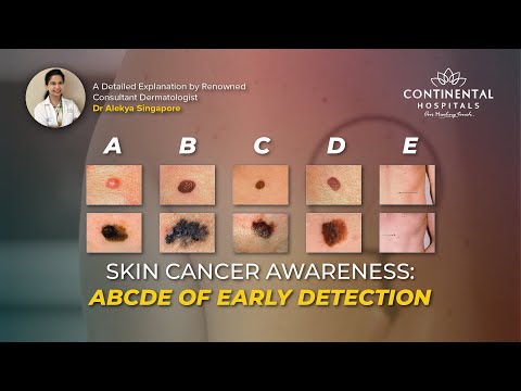 Skin Cancer Awareness: ABCDE of Early Detection- Dr. Alekya-Dermatologist, [Video]