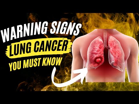 Warning Sign of Lung Cancer | How to Detect Lung Cancer Early | Signs of Lung Cancer in Males [Video]