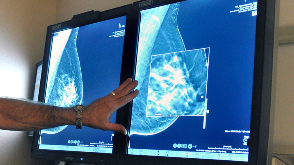 N.B. women aged 40 and over can self-refer to mammogram program [Video]