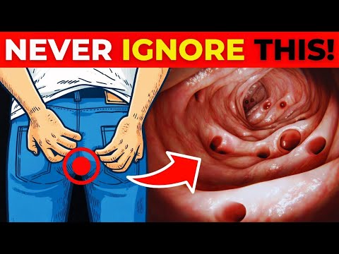 8 Critical Colon Cancer Symptoms You Should Never Ignore | Healthy Living Guide [Video]