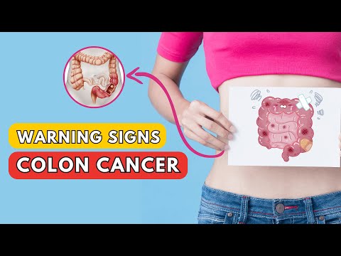 What is Colon Cancer | Warning Signs & Symptoms of Colon Cancer [Video]