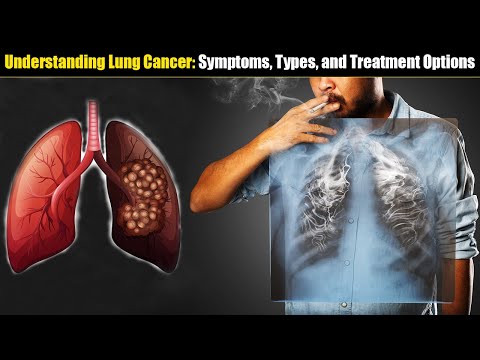 Lung Cancer Survival: Causes, Diagnosis, Treatment, and Management [Video]