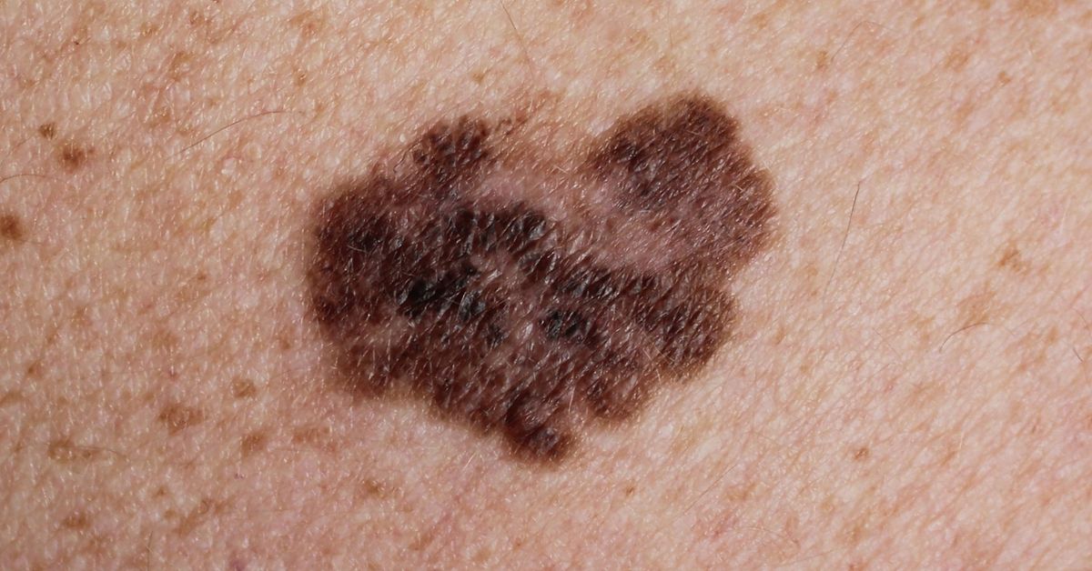 Melanoma vaccine lowers death, reoccurrence risk by 49 per cent, trial finds [Video]