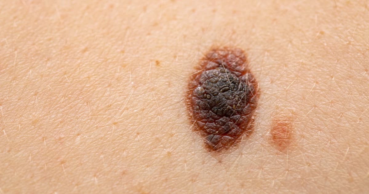 Melanoma recurrence risk cut by 49% by new vaccine/existing drug combo [Video]