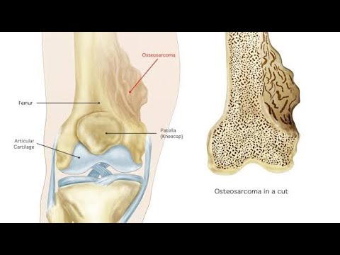 Osteosarcoma ; Definition, Causes, Symptoms and Treatment [Video]