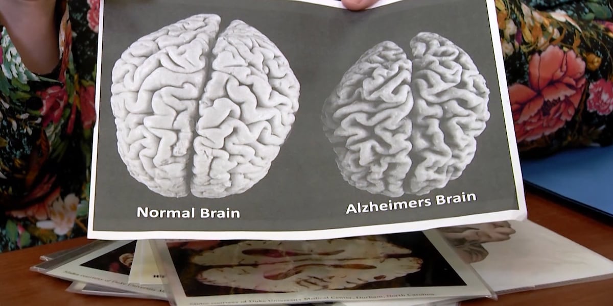Financial management may provide an early cue for dementia recognition [Video]