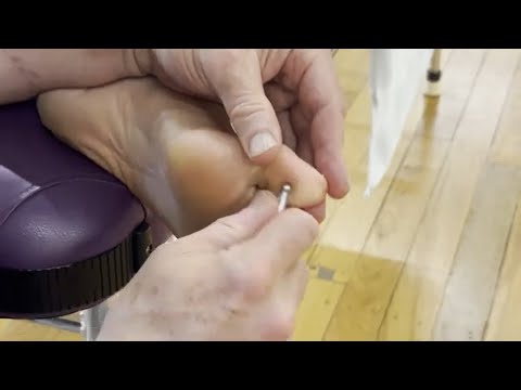 Deep foot reflexology massage with acupressure pen and other massage tools. Anger release. Josh pt 3 [Video]
