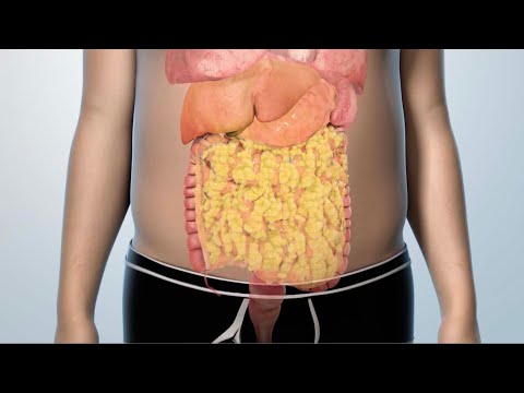Treatment Options for Type 2 Diabetes [Video]
