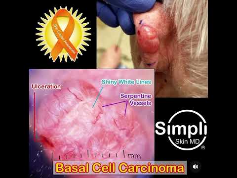 Basal Cell Carcinoma [Video]