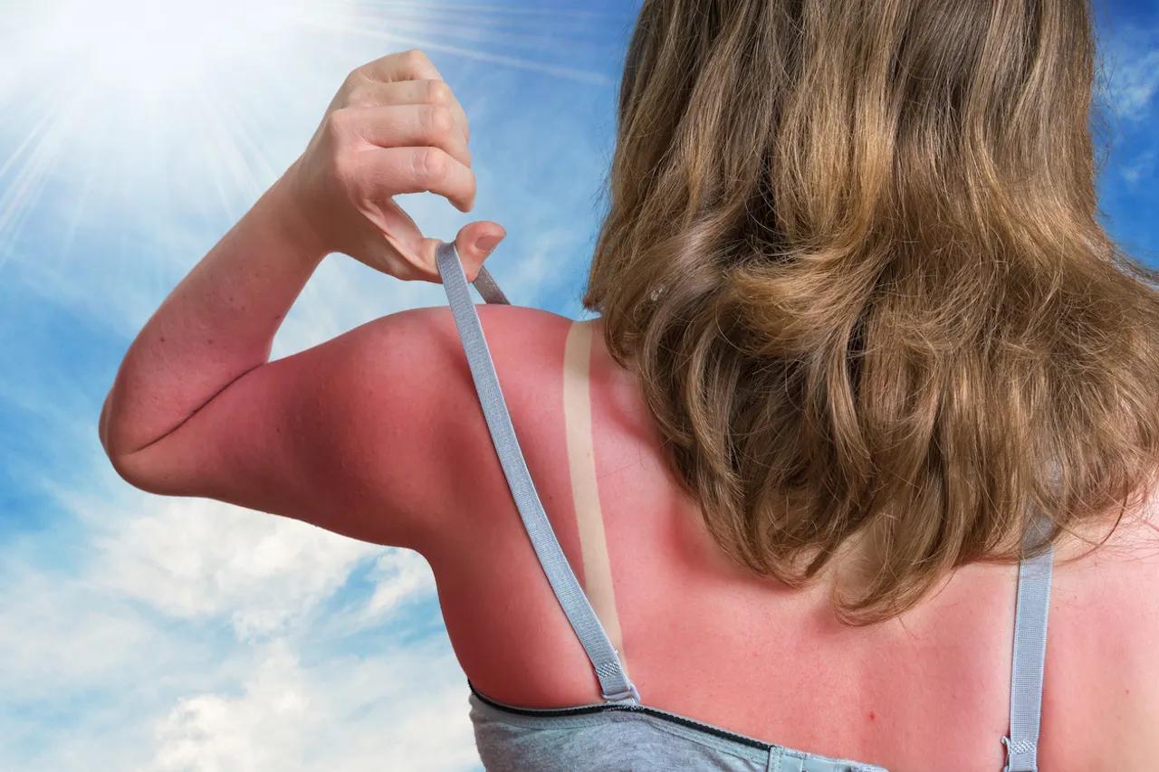 Sunburn SOS: 7 tips to soothe your sun-damaged skin, according to a wellness expert [Video]