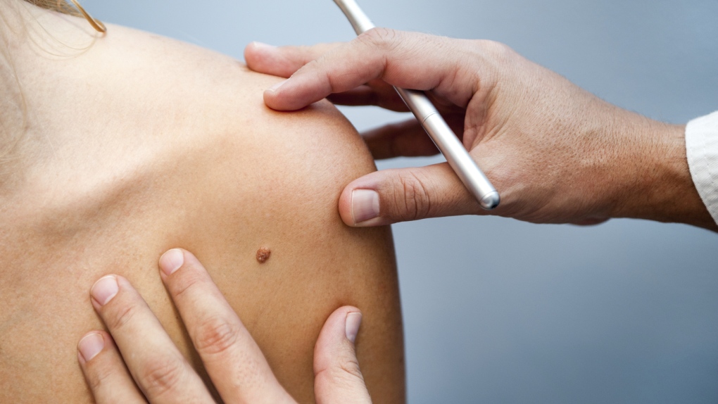 Skin cancer study looks at ways to diagnose, treat disease faster [Video]