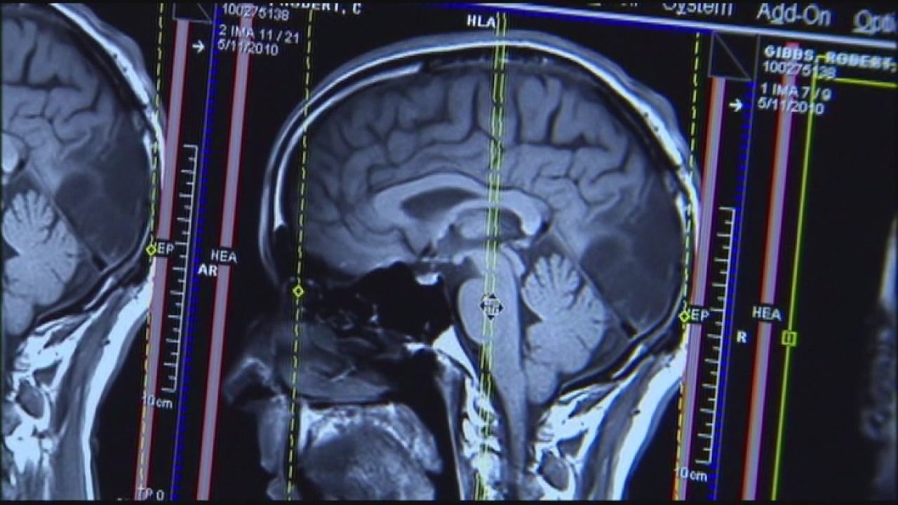 Northwestern Medicine achieves breakthrough in brain cancer treatment [Video]