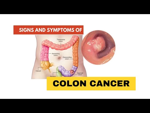 SIGNS AND SYMPTOMS OF COLON CANCER [Video]