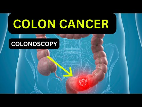 Colonoscopy and Colon Cancer Symptoms [Video]