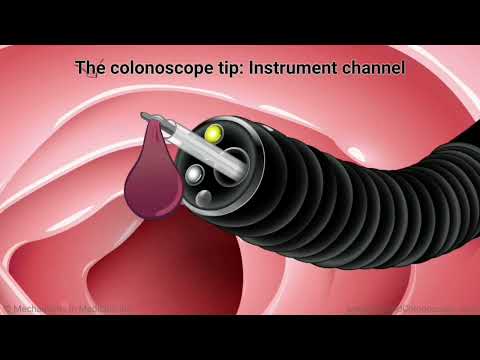 What is a colonoscopy (Voice over by Dr. Alaa Aljishy) [Video]