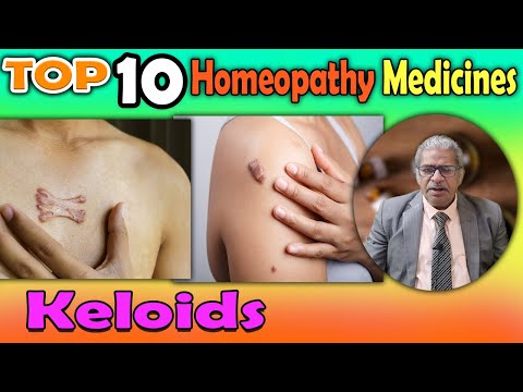 Keloids: Symptoms and #homeopathy medicines — Dr P S Tiwari [Video]