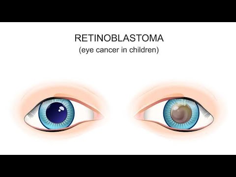 Retinoblastoma ; Causes, Symptoms, Diagnosis, Treatment and Prevention [Video]