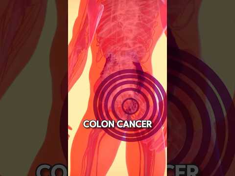 Never Ignore These COLON CANCER Signs [Video]