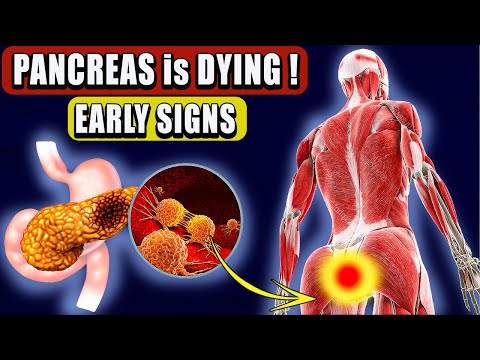 10 Symptoms of PANCREATIC CANCER That Will SHOCK YOU   Critical Warning Signs [Video]