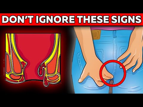 ALERT! Early Colon Cancer Signs You CANNOT Miss! [Video]