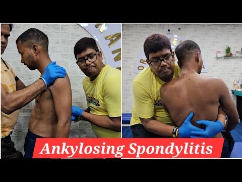 Chiropractic treatment for Ankylosing Spondylitis. [Video]