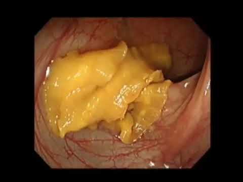 Tapeworm found during a colonoscopy. [Video]