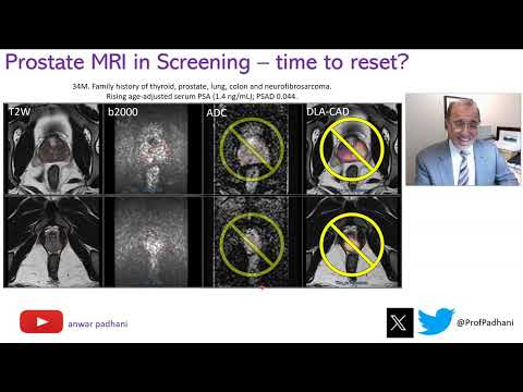 MRI in Prostate Cancer Screening  - Time to Reset [Video]