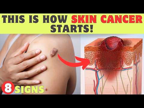 Top 8 Warning Signs of Skin Cancer [Video]