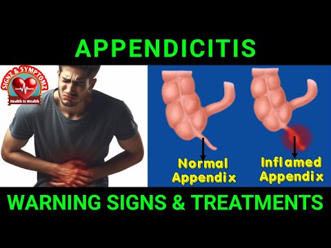 Appendicitis: Symptoms and Treatment Options [Video]