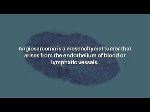 Primary Hepatic Angiosarcoma: Treatment Options for a Rare Tumor | Oncoscience [Video]