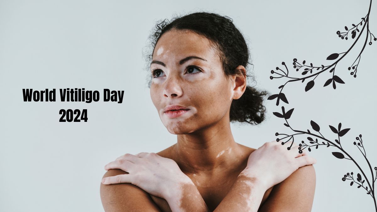 World Vitiligo Day 2024: Date, History, Significance And Slogans; Everything You Need To Know About This Day [Video]