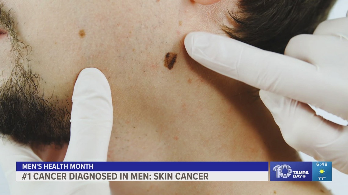 Dermatologist advises men to do their routine checks for skin cancer [Video]