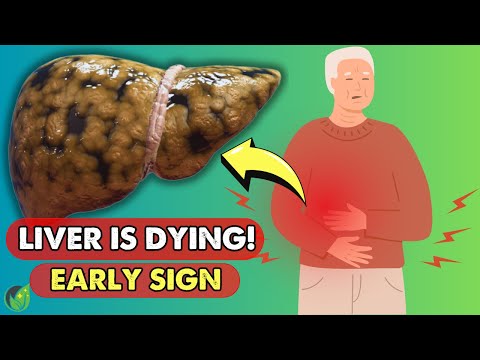 Is Your Liver Dying? 17 Critical Symptoms You Must Know!| Health Journey [Video]
