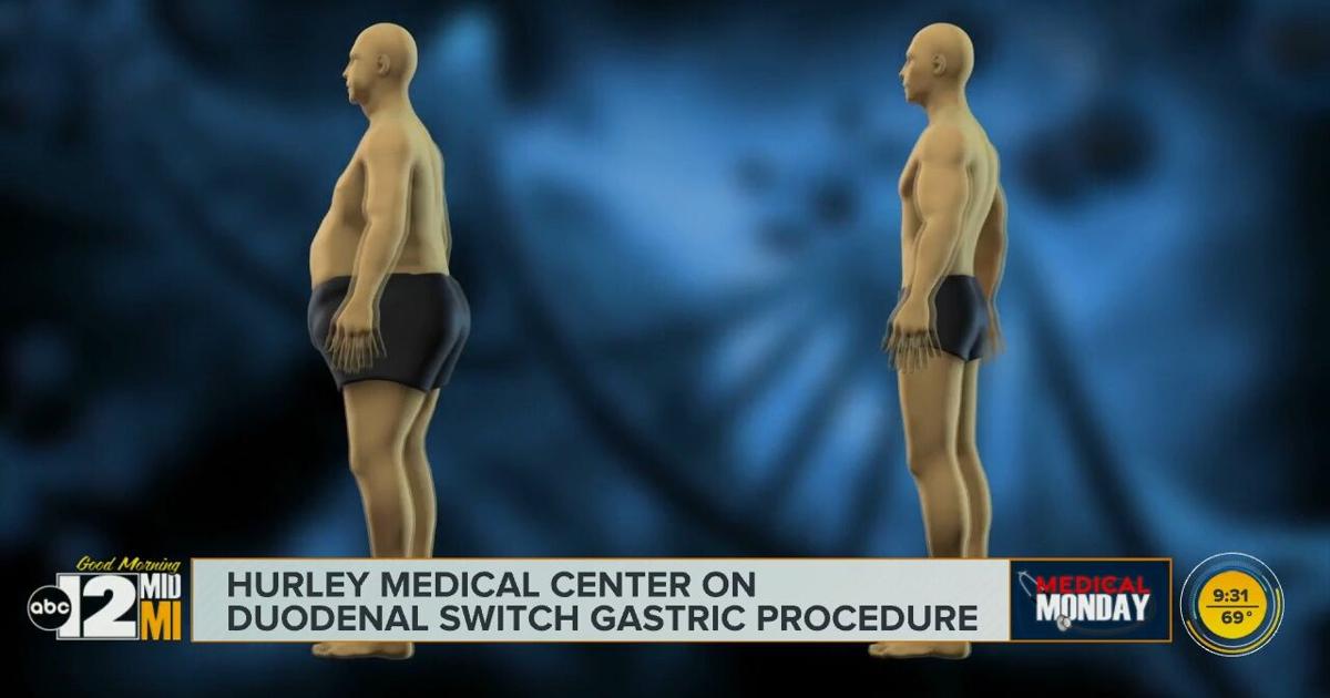Medical Monday: Hurley Medical Center discusses a weight loss procedure | Community [Video]