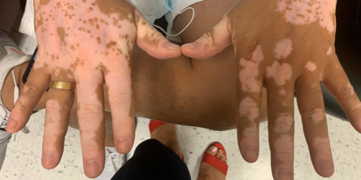Treatment options seeing improved results for people living with vitiligo [Video]