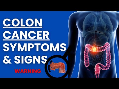 Colon Cancer Symptoms And Signs You Should NEVER Ignore!! [Video]
