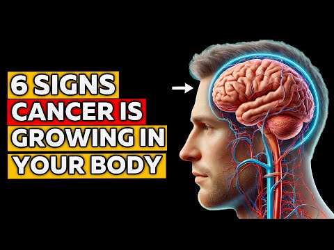 Don’t Miss These 6 Early CANCER Signs – It Could Save You! [Video]