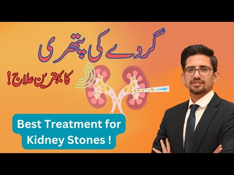 Understanding Kidney Stone Treatment: Options and Recovery ! [Video]