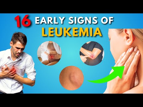 16 Early Signs of Leukemia You Should Never Ignore | Blood Cancer Symptoms [Video]