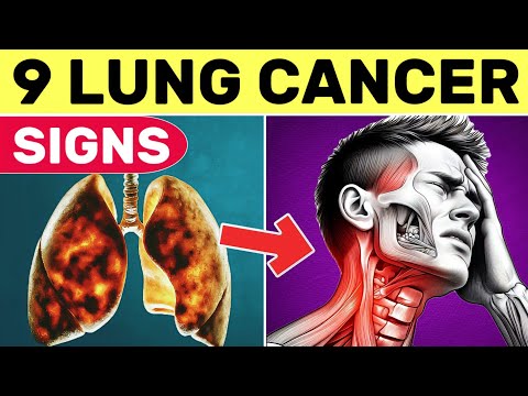 9 Early signs of lung cancer || Lung cancer symptoms || Lung carcinoma [Video]
