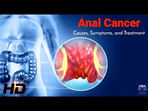 Anal Cancer Facts: What Causes It and How to Fight It [Video]