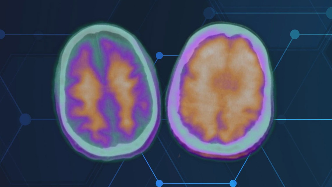 UT Health neurologist leads groundbreaking Alzheimer’s drug trial [Video]