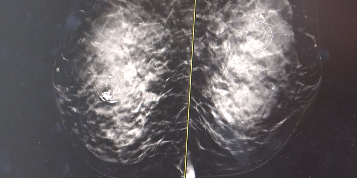 Do you have dense breast tissue? It could put you at higher risk for cancer [Video]