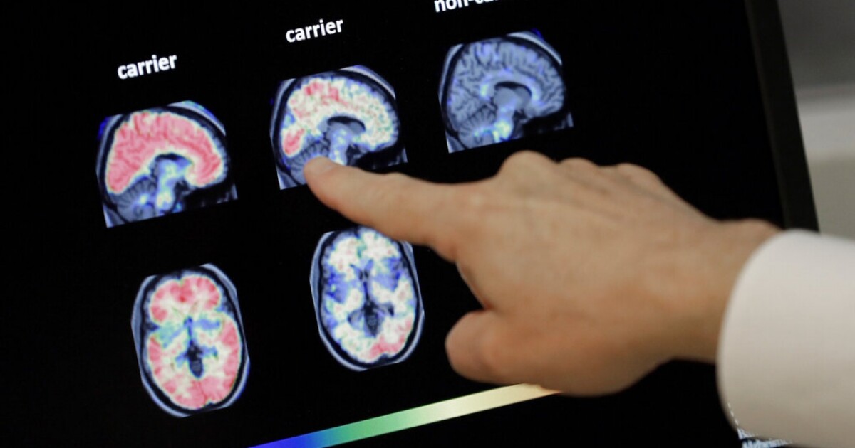 FDA approves Alzheimer’s drug that may slow memory decline in those with disease [Video]