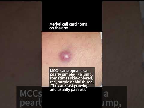 What does Skin Cancer look like? Merkel Cell Carcinoma [Video]