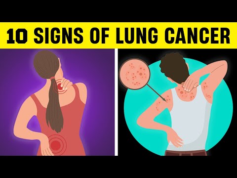 10 Lung Cancer Signs That 90% of People Ignore [Video]