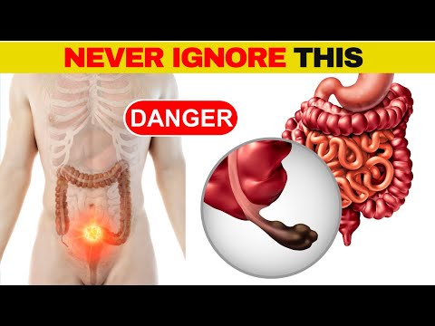 8 Critical COLON CANCER Symptoms You Should NEVER Ignore | Stay Healthy! [Video]