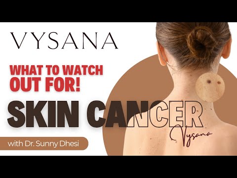 Skin Cancer – What to Look Out For | Dr. Sunny Dhesi’s Expert Advice | Vysana Wellness Clinic [Video]